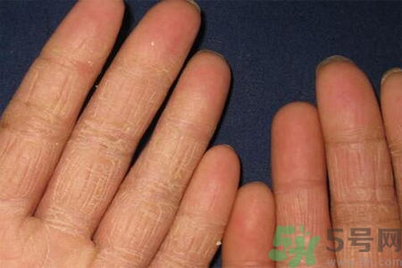 手足癬的治療方法？治療手足癬可以用什么藥？