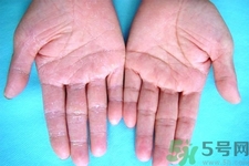 手足癬的治療方法？治療手足癬可以用什么藥？