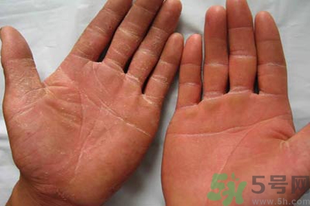 手足癬的治療方法？治療手足癬可以用什么藥？