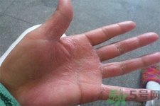 手足癬的易發(fā)人群有哪些？如何預(yù)防手足癬？