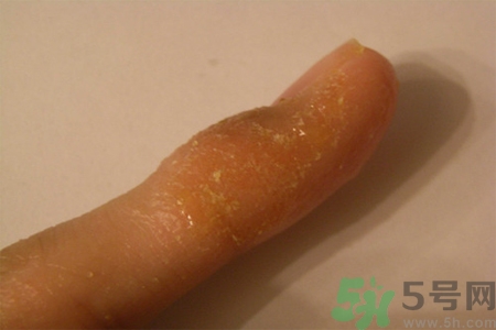 手足癬的易發(fā)人群有哪些？如何預(yù)防手足癬？