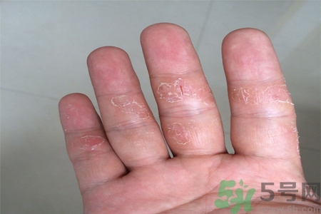 手足癬的易發(fā)人群有哪些？如何預(yù)防手足癬？