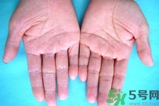 手足癬預(yù)防措施需要注意什么？手足癬飲食要注意哪些？