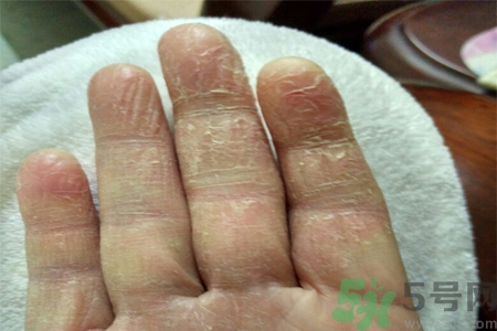 手足癬會(huì)傳染嗎？手足癬的傳播途徑有哪些？