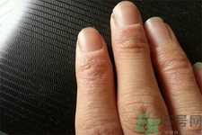 手足癬會(huì)傳染嗎？手足癬的傳播途徑有哪些？