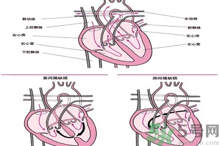 先天性心臟病是什么？先天性心臟病的癥狀有哪些？