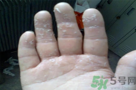 手足癬的易發(fā)人群有哪些？如何預(yù)防手足癬？