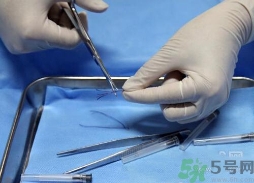 埋線減肥有效嗎？埋線減肥多久有效？