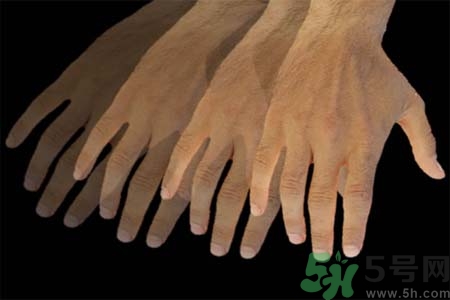 帕金森會(huì)有遺傳性嗎？帕金森需注意什么？