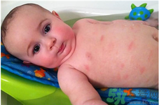 寶寶秋季過敏性皮炎是什么引起的？寶寶秋季過敏性皮炎的預防及治療