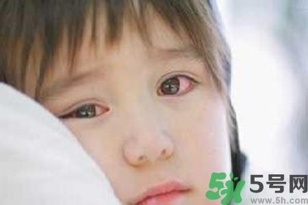 寶寶為什么會感染紅眼病？寶寶患紅眼病如何治療？