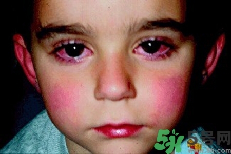 寶寶為什么會感染紅眼病？寶寶患紅眼病如何治療？