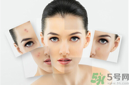 下巴長硬包是怎么回事？下巴長硬包怎么辦？