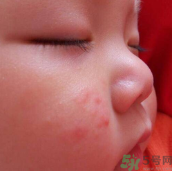 寶寶長(zhǎng)蘚是怎么回事？寶寶長(zhǎng)蘚怎么辦？
