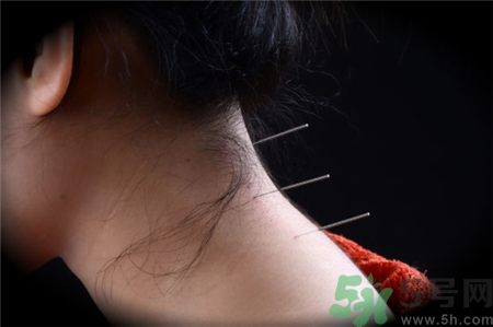 針灸時頭暈胸悶是什么原因?針灸暈針怎么辦? 針灸時頭暈胸悶是什么原因?針灸暈針怎么辦?