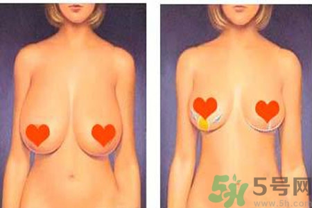 ?女性乳房下垂的原因是什么？女性乳房下垂的分類(lèi)有哪些？