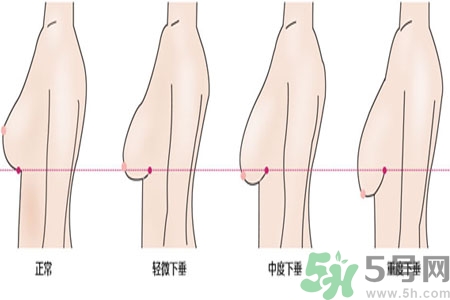 ?女性乳房下垂的原因是什么？女性乳房下垂的分類(lèi)有哪些？