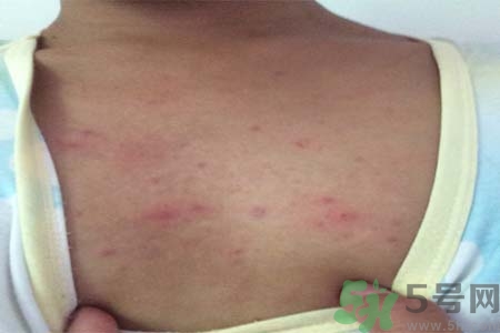 胸部長(zhǎng)痘痘怎么回事？胸部長(zhǎng)痘痘的原因是什么？