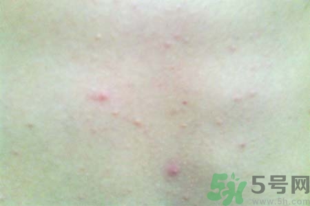 胸部長(zhǎng)痘痘怎么回事？胸部長(zhǎng)痘痘的原因是什么？