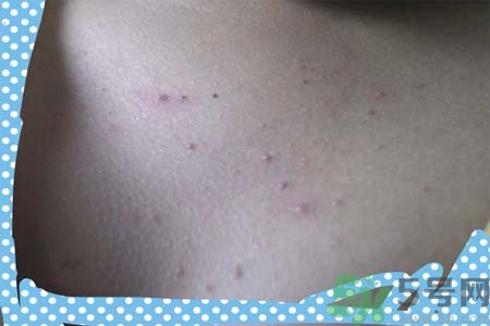 胸部長痘痘怎么辦？胸部長痘痘需要注意什么？