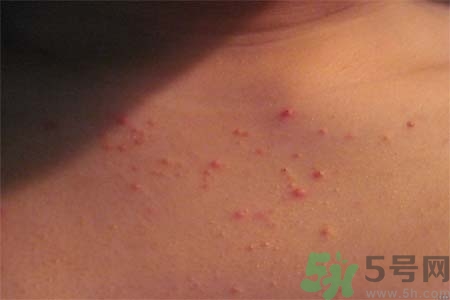 胸部長痘痘怎么辦？胸部長痘痘需要注意什么？