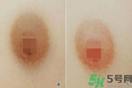 乳頭發(fā)黑怎么辦？怎么樣可以使乳頭變白？