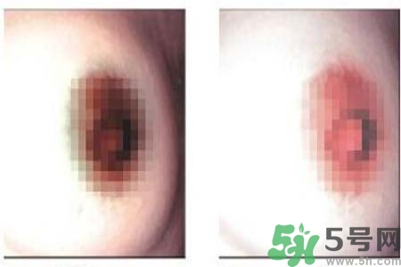 乳頭發(fā)黑怎么辦？怎么樣可以使乳頭變白？