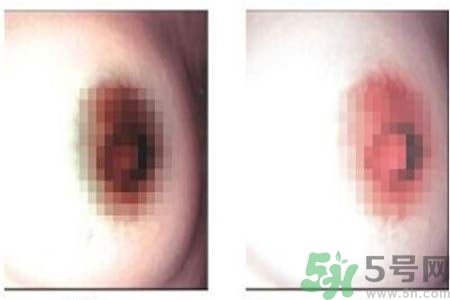 乳頭發(fā)黑是怎么回事？乳頭發(fā)黑是什么原因？