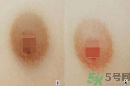 乳頭發(fā)黑是怎么回事？乳頭發(fā)黑是什么原因？
