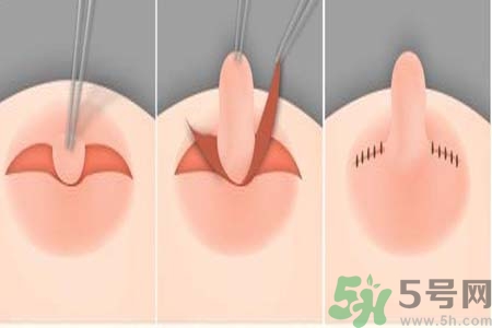 乳頭內(nèi)陷怎么回事？乳頭內(nèi)陷的原因是什么？