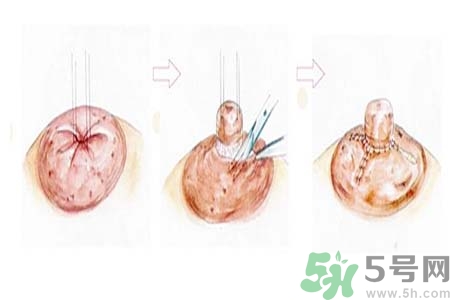 乳頭內(nèi)陷怎么回事？乳頭內(nèi)陷的原因是什么？