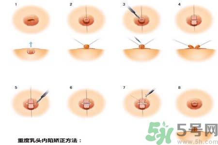 乳頭內(nèi)陷怎么回事？乳頭內(nèi)陷的原因是什么？