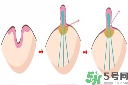 乳頭內(nèi)陷怎么辦？乳頭內(nèi)陷的癥狀有哪些？