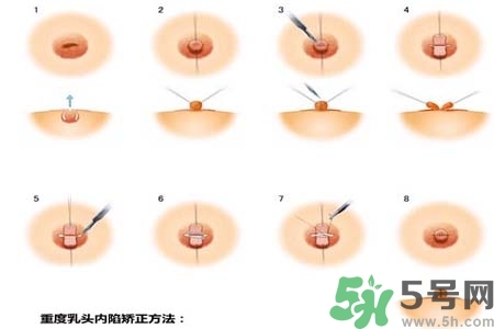 乳頭內(nèi)陷怎么辦？乳頭內(nèi)陷的癥狀有哪些？