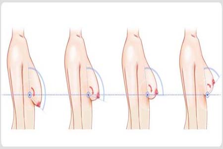 胸部松弛的原因是什么？胸部松弛該怎么辦？