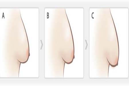 如何預防胸部松弛？吃什么能使胸部挺拔？