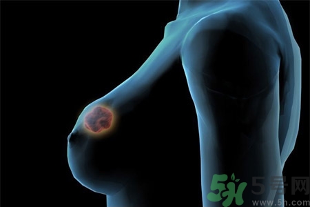 乳房有硬塊正常嗎？乳房有腫塊怎么回事？