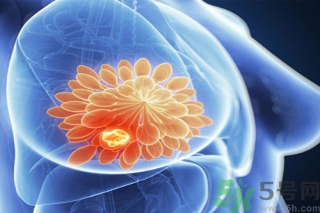 乳房屋硬塊有疼痛感怎么回事？乳房屋硬塊有疼痛感怎么辦？