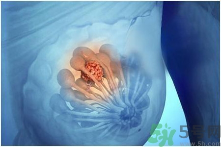 怎樣區(qū)分乳房包塊是良性還是惡性？如何診斷乳房腫塊是惡性還是良性？