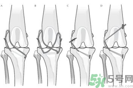 前十字韌帶斷裂可以參加比賽嗎？前十字韌帶斷裂怎么治療？