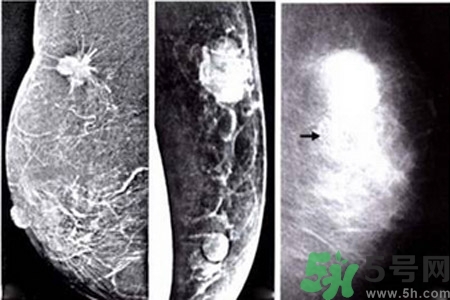 產(chǎn)生乳腺增生鈣化的病因是什么？乳腺增生怎樣治療？