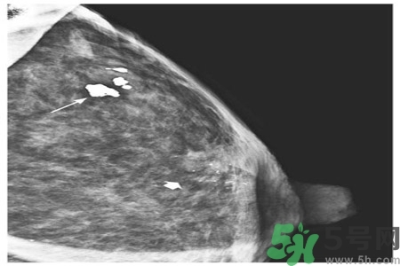 乳腺增生鈣化是什么？乳腺鈣化的癥狀有哪些？