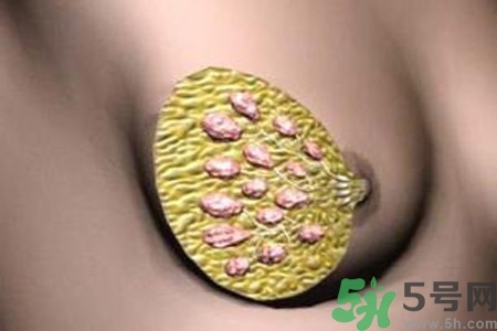 乳腺增生鈣化是什么？乳腺鈣化的癥狀有哪些？