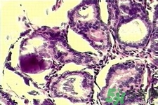 乳腺增生鈣化是什么？乳腺鈣化的癥狀有哪些？