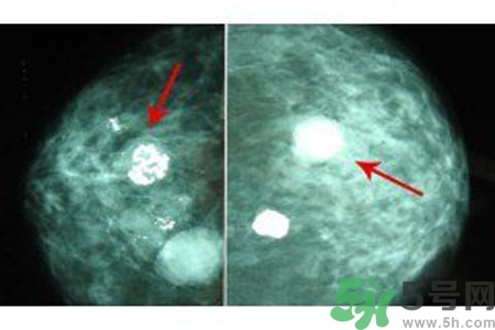 乳腺增生鈣化是什么？乳腺鈣化的癥狀有哪些？