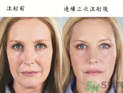 3D液態(tài)拉皮多少錢？3D液態(tài)拉皮后多久見效？