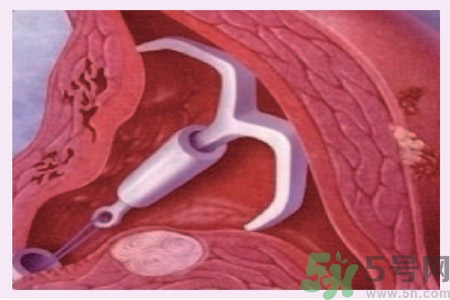 什么是自然避孕法？如何能知道自己的孕期？