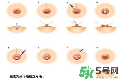 乳頭內(nèi)陷怎么矯正？乳頭內(nèi)陷矯正方法是什么？