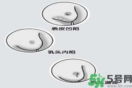 乳頭內(nèi)陷怎么矯正？乳頭內(nèi)陷矯正方法是什么？