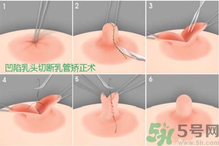 乳頭內(nèi)陷怎么矯正？乳頭內(nèi)陷矯正方法是什么？